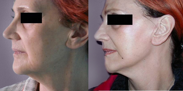 Facelifting – nakon 6 mjeseci